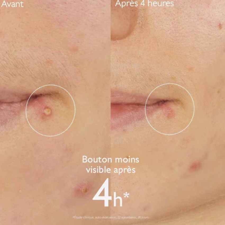 CAUDALIE - VINOPURE STOP BOUTONS 15ML